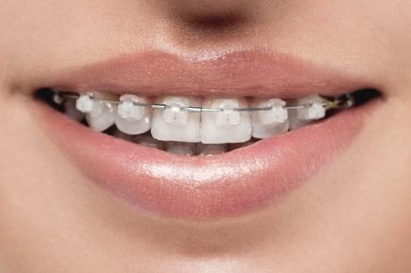 Ceramic braces example at Align Beauty Orthodontics