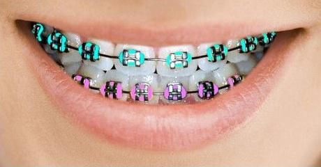 traditional metal braces at Align Beauty Orthodontics