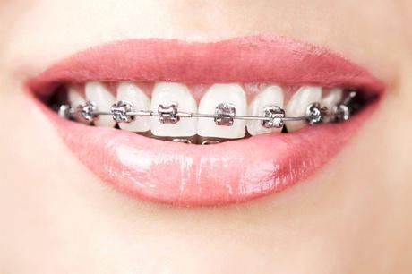 self litigating braces to align teeth in Dublin, OH