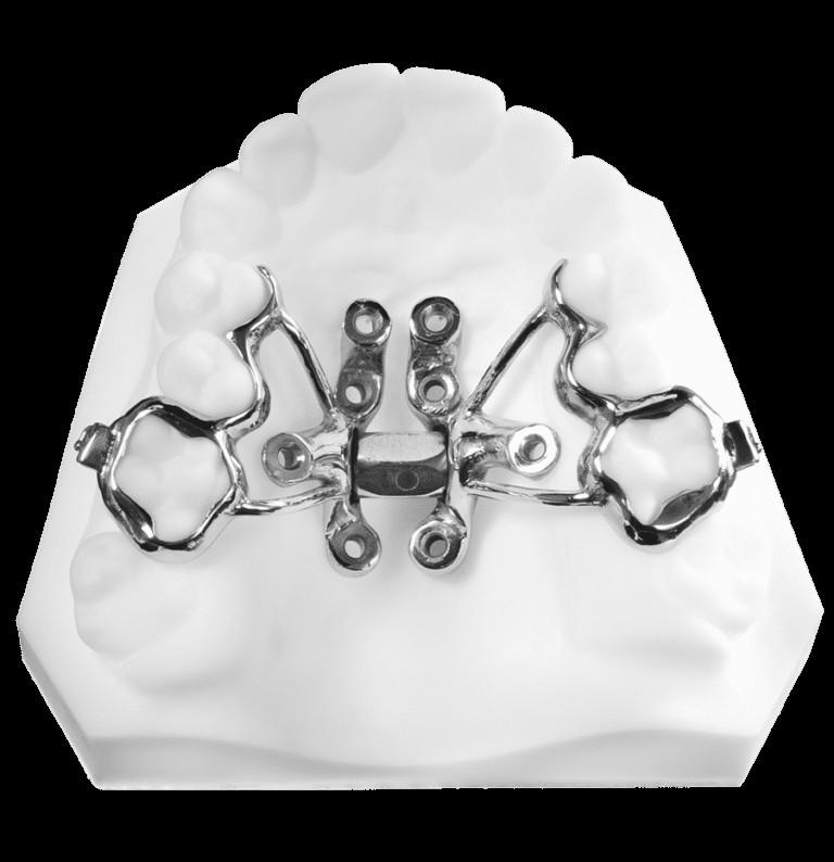 picture of palatal | skeletal expansion to help widen narrow jaw