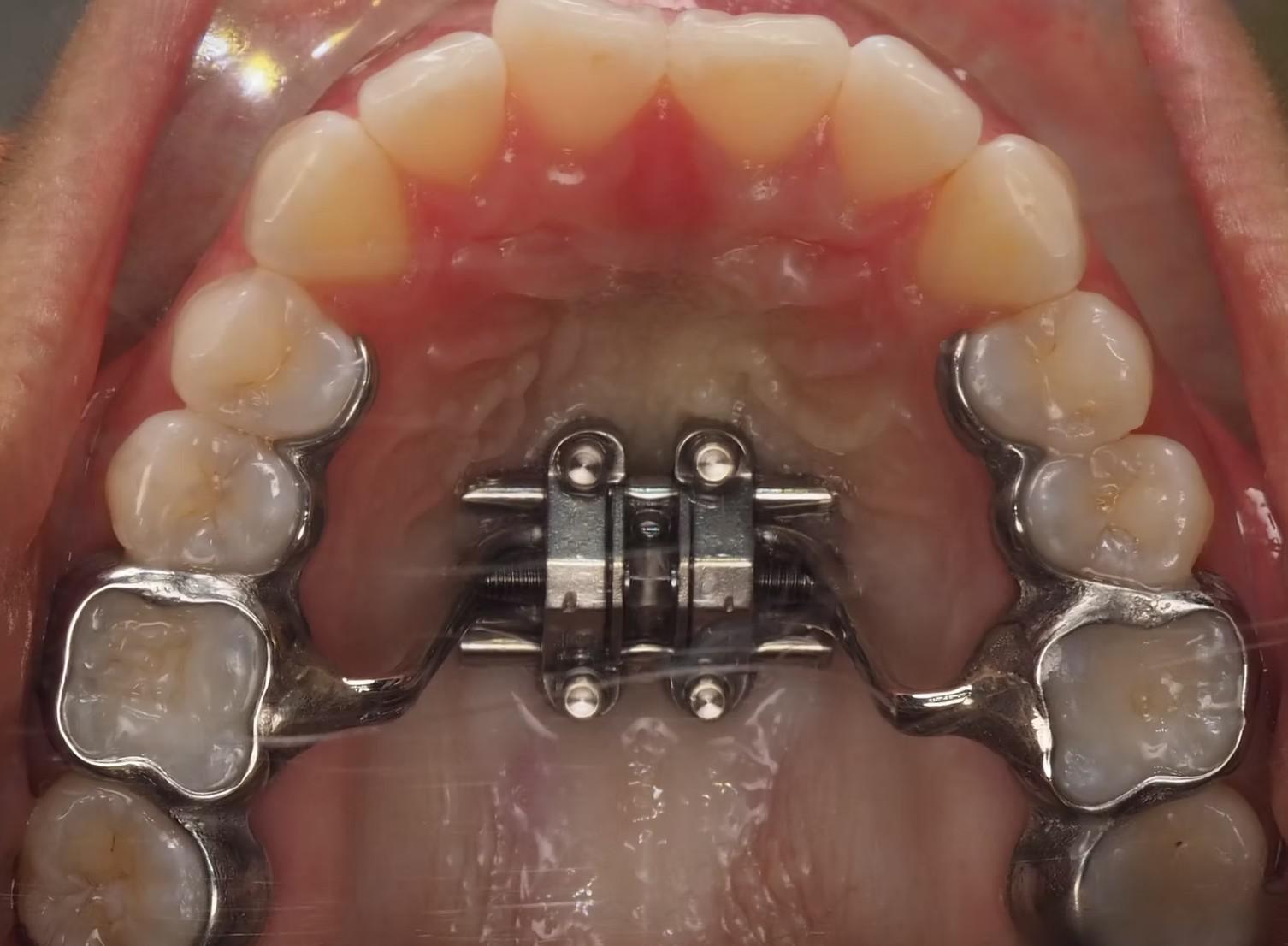 Picture of a patients mouth with palatal expander in orthodontics